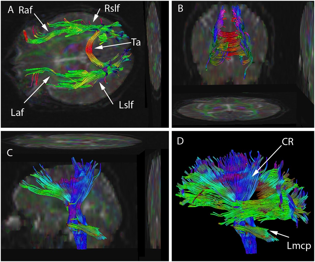 Diffusion-tensor-imaging tractography showing colored white-matter fiber tracts of a human brain from four angles.