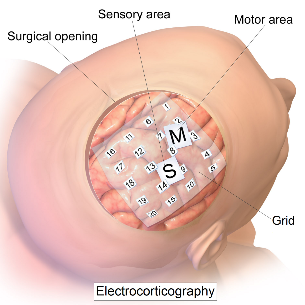 Medical illustration of an electrocorticography electrode grid placed on the surface of the cerebral cortex over sensory and motor areas during surgery.